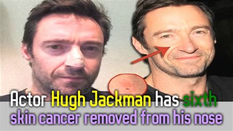 hugh jackman skin cancer on nose